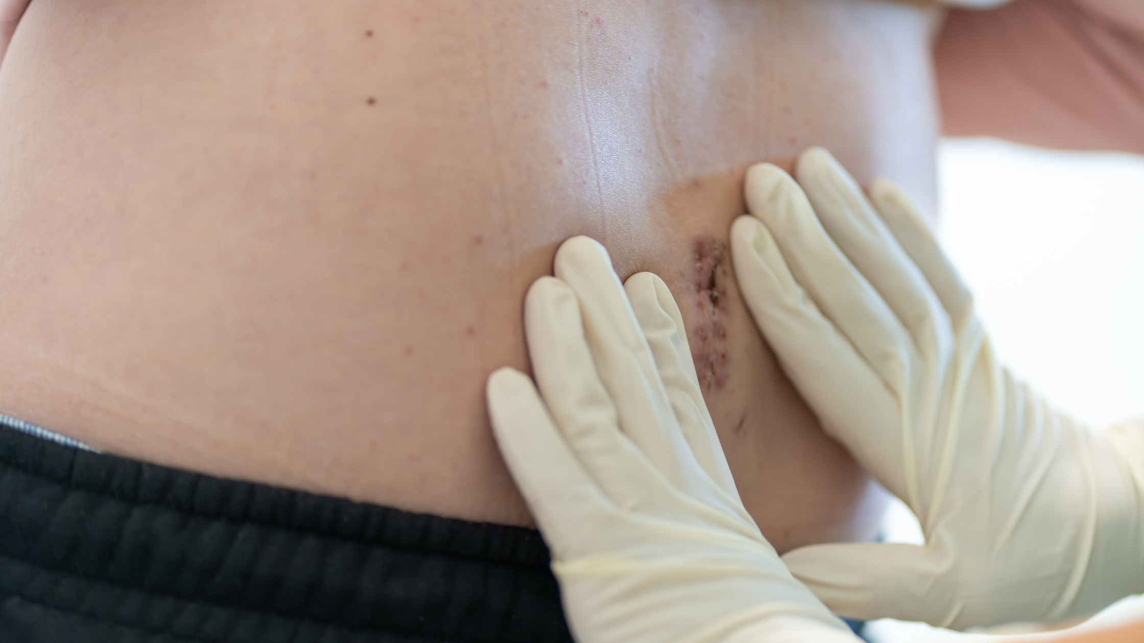 hernia needs surgery